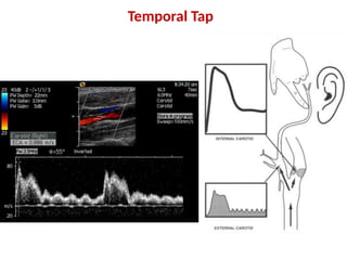 Carotid and transcranial duplex complete examination | PPTX