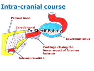 Petrous bone
Carotid canal
Internal carotid a.
Cartilage closing the
lower aspect of foramen
lacerum
Cavernous sinus
Intra...