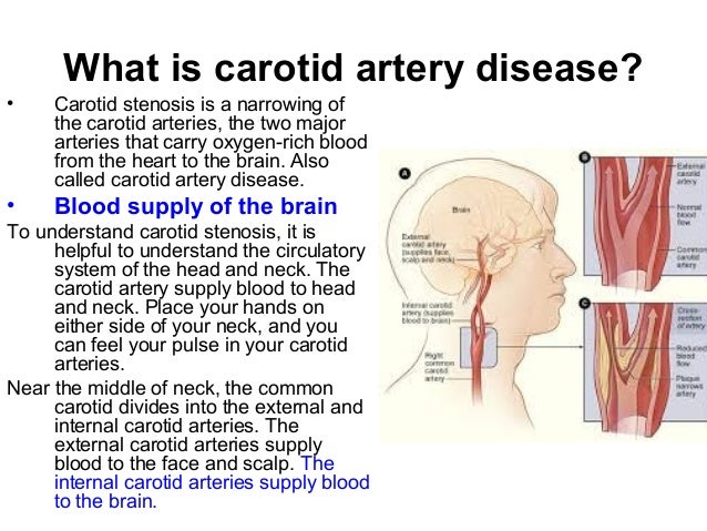 Carotid Artery Disease