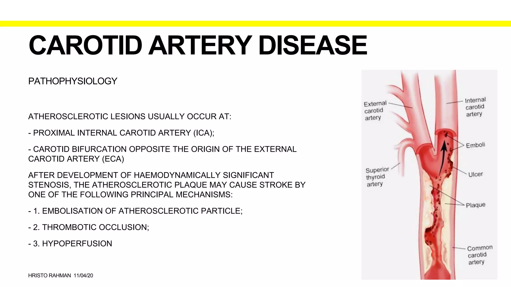 Carotid Artery Disease PPTX carotid-artery-disease-pptx