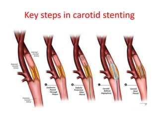 Carotid artery diseases and carotid stenting | PPTX