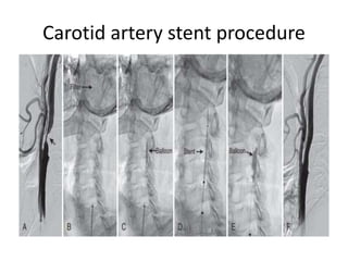 Carotid artery diseases and carotid stenting | PPTX