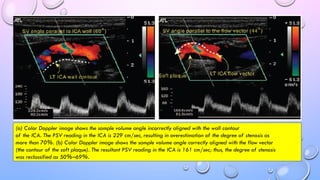 Carotid Doppler Ultrasound: Principles and Pitfalls | PPTX