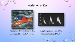 Carotid Doppler Ultrasound: Principles and Pitfalls | PPTX