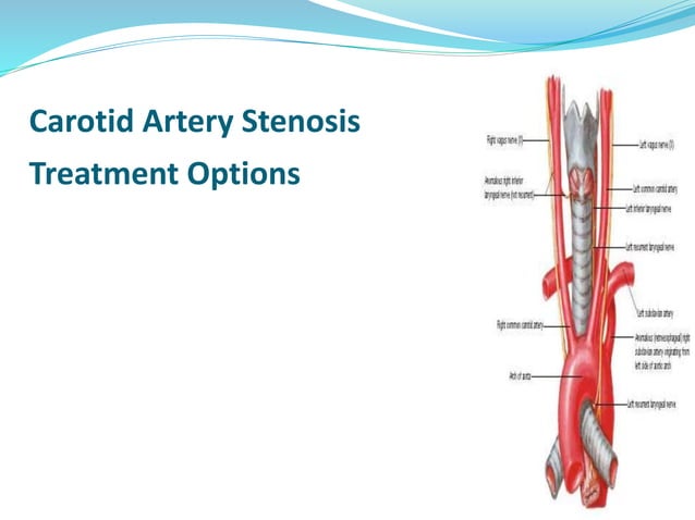 Carotid Artery Stenosis Treatment Options | PPT