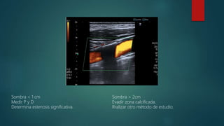 Sombra < 1 cm Sombra > 2cm
Medir P y D Evadir zona calcificada.
Determina estenosis significativa. Rralizar otro método de estudio.
 
