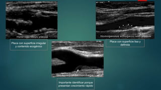 Placa con superficie lisa y
definida
Placa con superficie irregular
y contenido ecogénico
Importante identificar porque
presentan crecimiento rápido
 