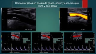 Demostrar placa en escala de grises, poder y espectros pre,
trans y post placa
 