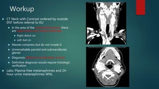 Workup
 CT Neck with Contrast ordered by outside
ENT before referral to KU
 In the area of the carotid bifurcations there
are large enhancing masses bilaterally
 Right: 8x4x3 cm
 Left: 6x4 cm
 Masses compress but do not invade IJ
 Unremarkable parotid and submandibular
glands
 Diagnosis: Bilateral Carotid Body Tumors
 Definitive diagnosis would require histologic
verification
 Labs: Plasma-free metanephrines and 24-
hour urine metanephrines WNL
 