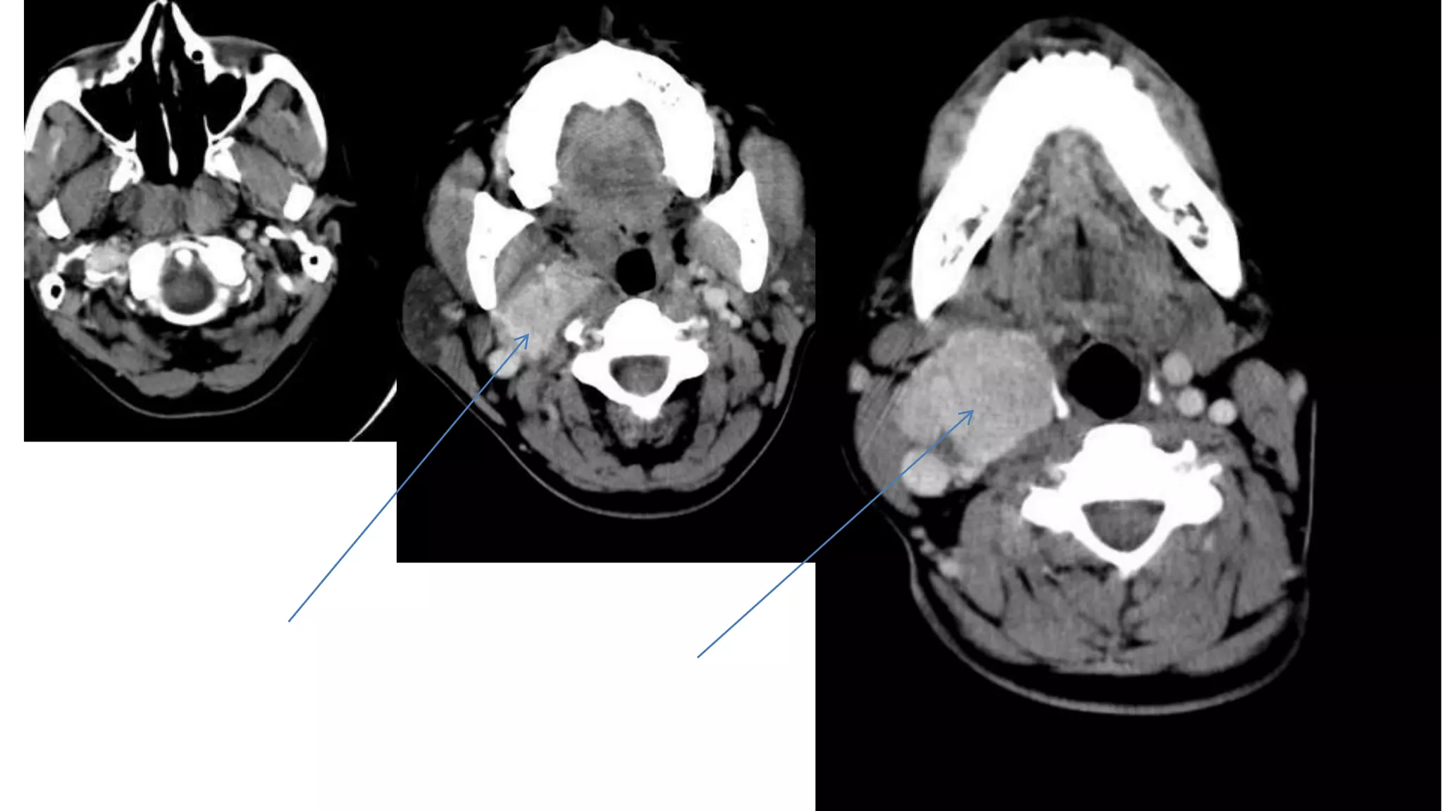 Carotid body tumors | PPTX