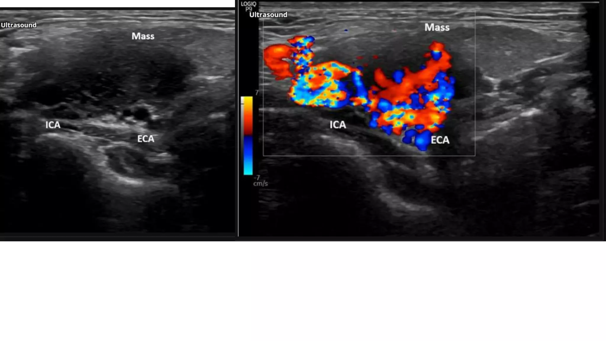 Carotid body tumors | PPTX