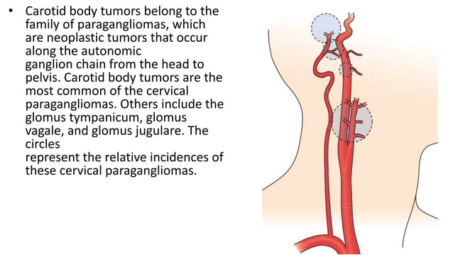 Carotid body tumors | PPTX | Ear, Nose and Throat Conditions | Diseases ...