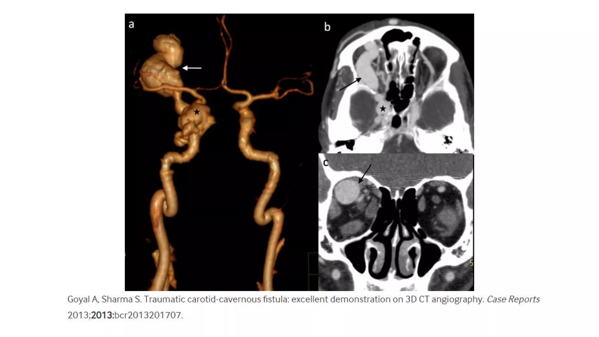 Carotid Cavernous Fistulas PPTX carotid-cavernous-fistulas-pptx