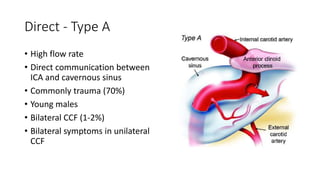 Direct - Type A
• High flow rate
• Direct communication between
ICA and cavernous sinus
• Commonly trauma (70%)
• Young males
• Bilateral CCF (1-2%)
• Bilateral symptoms in unilateral
CCF
 
