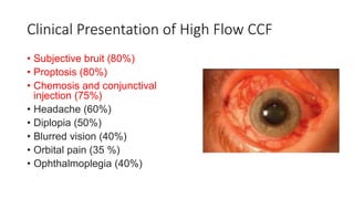 Clinical Presentation of High Flow CCF
• Subjective bruit (80%)
• Proptosis (80%)
• Chemosis and conjunctival
injection (75%)
• Headache (60%)
• Diplopia (50%)
• Blurred vision (40%)
• Orbital pain (35 %)
• Ophthalmoplegia (40%)
 