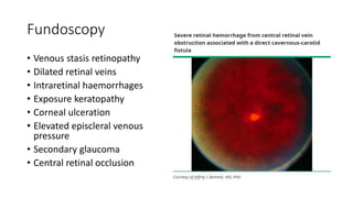 Fundoscopy
• Venous stasis retinopathy
• Dilated retinal veins
• Intraretinal haemorrhages
• Exposure keratopathy
• Corneal ulceration
• Elevated episcleral venous
pressure
• Secondary glaucoma
• Central retinal occlusion
 