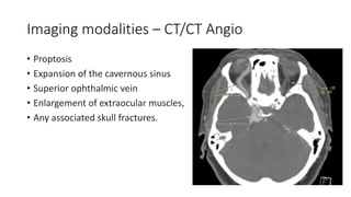 Imaging modalities – CT/CT Angio
• Proptosis
• Expansion of the cavernous sinus
• Superior ophthalmic vein
• Enlargement of extraocular muscles,
• Any associated skull fractures.
 