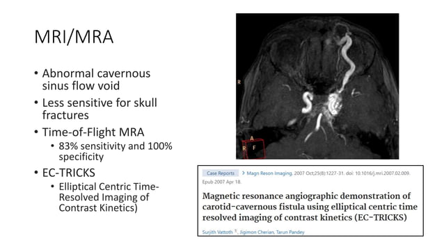 Carotid Cavernous Fistulas | PPTX