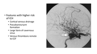 • Features with higher risk
of ICH
• Cortical venous drainage
• Pseudoaneurysm
formation
• Large Varix of cavernous
sinus
• Venous thrombosis remote
to CCF
 