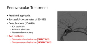 Endovascular Treatment
• Preferred approach.
• Successful closure rates of 55-85%
• Complications (10-40%)
• ICA occlusion
• Cerebral infarction
• Worsened ocular palsy
• Two methods
• Transarterial embolization (DIRECT CCF)
• Transvenous embolization (INDIRECT CCF)
 