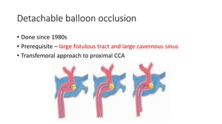 Detachable balloon occlusion
• Done since 1980s
• Prerequisite – large fistulous tract and large cavernous sinus
• Transfemoral approach to proximal CCA
 