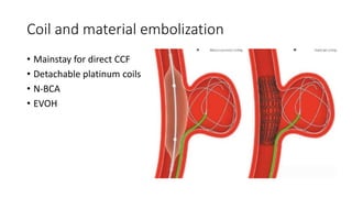 Coil and material embolization
• Mainstay for direct CCF
• Detachable platinum coils
• N-BCA
• EVOH
 