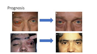 Prognosis
 