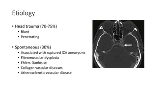 Etiology
• Head trauma (70-75%)
• Blunt
• Penetrating
• Spontaneous (30%)
• Associated with ruptured ICA aneurysms
• Fibromuscular dysplasia
• Ehlers-Danlos sx
• Collagen vascular diseases
• Atherosclerotic vascular disease
 