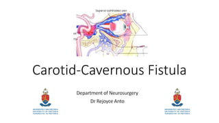 Carotid-Cavernous Fistula
Department of Neurosurgery
Dr Rejoyce Anto
 