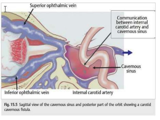 Carotid Cavernous Fistula PPTX First Aid Injuries
