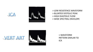 > LOW RESISTENCE WAVEFORM
> BLUNTED SYSTOLIC PEAK
> HIGH DIASTOLIC FLOW
> WIDE SPECTRAL ENVELOPE
> WAVEFORM
PATTERN SIMILAR TO
ICA
 
