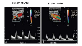 PSV-305 CM/SEC PSV-85 CM/SEC
 