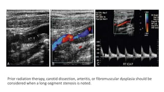 Prior radiation therapy, carotid dissection, arteritis, or fibromuscular dysplasia should be
considered when a long-segment stenosis is noted.
 