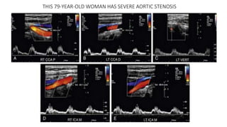 THIS 79-YEAR-OLD WOMAN HAS SEVERE AORTIC STENOSIS
 