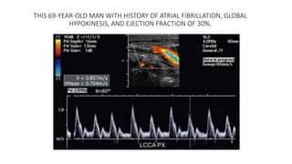THIS 69-YEAR-OLD MAN WITH HISTORY OF ATRIAL FIBRILLATION, GLOBAL
HYPOKINESIS, AND EJECTION FRACTION OF 30%.
 