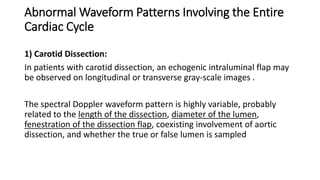 Abnormal Waveform Patterns Involving the Entire
Cardiac Cycle
1) Carotid Dissection:
In patients with carotid dissection, an echogenic intraluminal flap may
be observed on longitudinal or transverse gray-scale images .
The spectral Doppler waveform pattern is highly variable, probably
related to the length of the dissection, diameter of the lumen,
fenestration of the dissection flap, coexisting involvement of aortic
dissection, and whether the true or false lumen is sampled
 