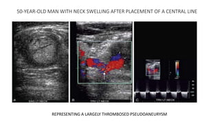 50-YEAR-OLD MAN WITH NECK SWELLING AFTER PLACEMENT OF A CENTRAL LINE
REPRESENTING A LARGELY THROMBOSED PSEUDOANEURYSM
 