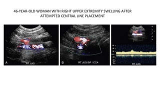 46-YEAR-OLD WOMAN WITH RIGHT UPPER EXTREMITY SWELLING AFTER
ATTEMPTED CENTRAL LINE PLACEMENT
 