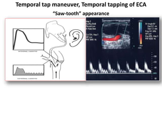Carotid Doppler | PPT