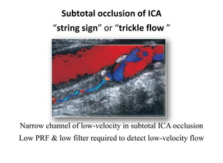 Carotid Doppler | PPT
