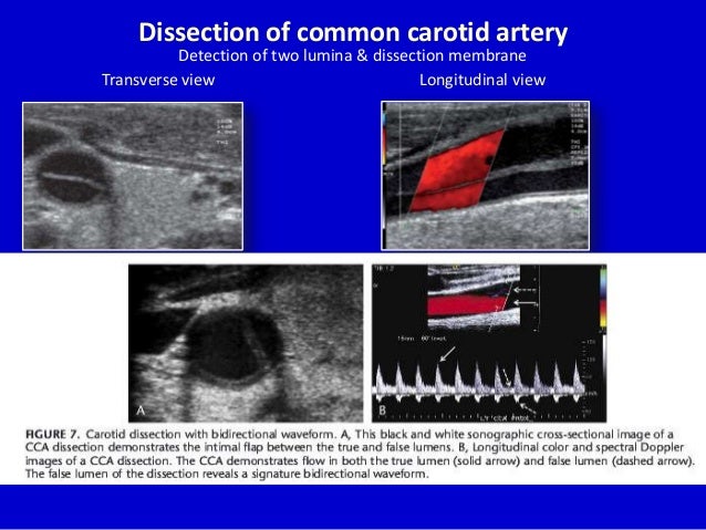 Carotid doppler II