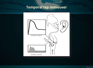 Carotid doppler study pk | PPTX