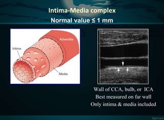 Carotid doppler study pk | PPTX