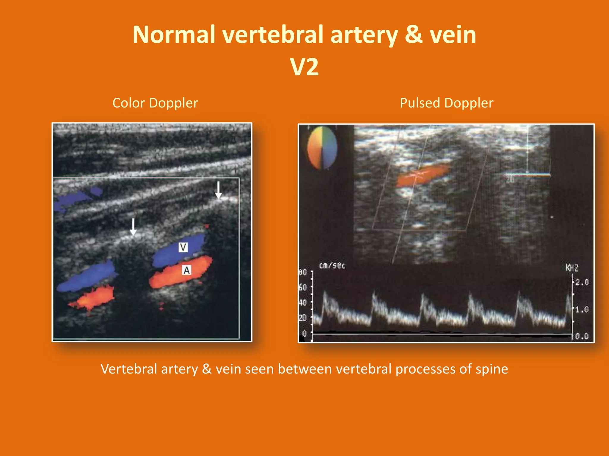 Normal vertebral artery & vein
V2
Color Doppler

Pulsed Doppler

Vertebral artery & vein seen between vertebral processes of spine

 