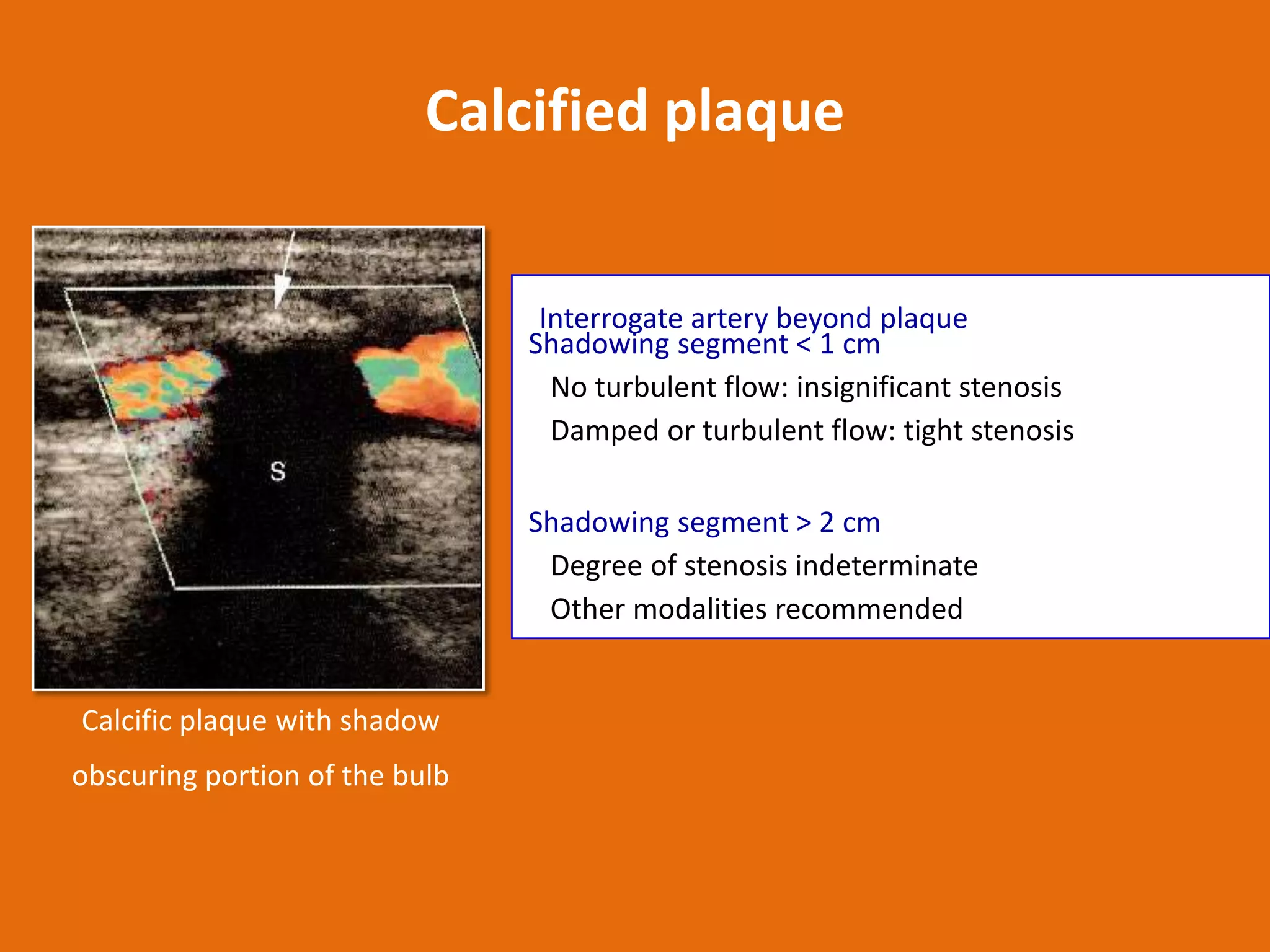 Calcified plaque
Interrogate artery beyond plaque
Shadowing segment < 1 cm
No turbulent flow: insignificant stenosis
Damped or turbulent flow: tight stenosis
Shadowing segment > 2 cm
Degree of stenosis indeterminate
Other modalities recommended

Calcific plaque with shadow
obscuring portion of the bulb

 