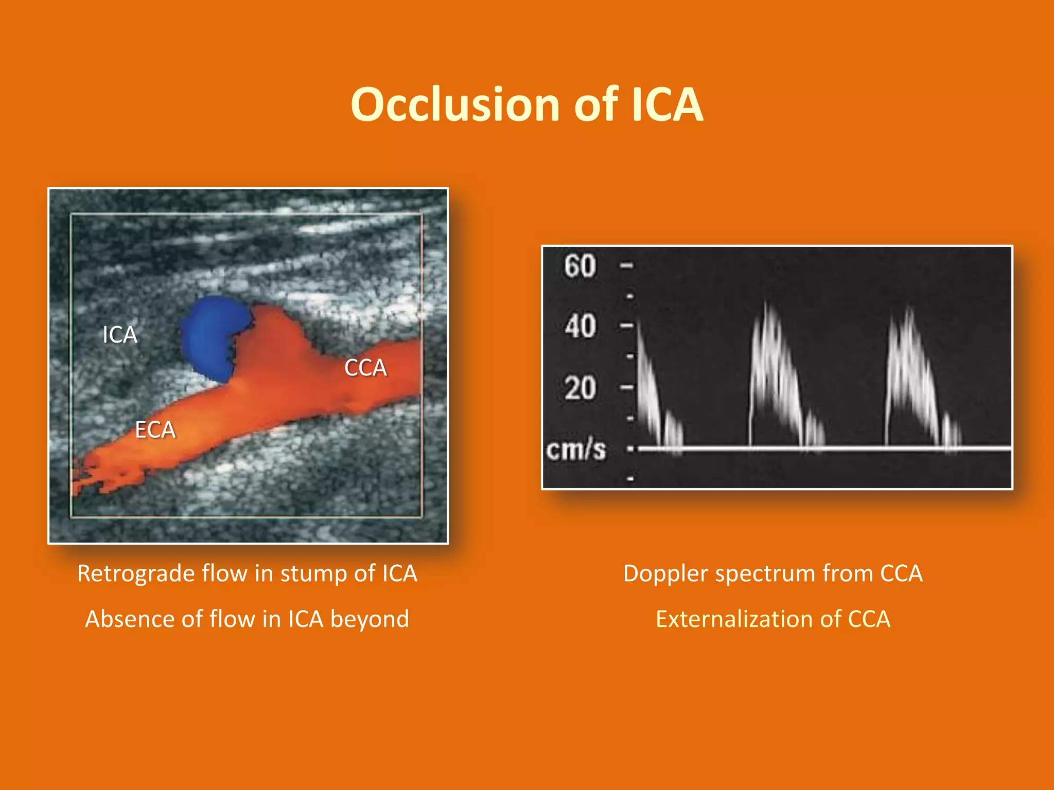 Occlusion of ICA

ICA
CCA
ECA

Retrograde flow in stump of ICA

Doppler spectrum from CCA

Absence of flow in ICA beyond

Externalization of CCA

 