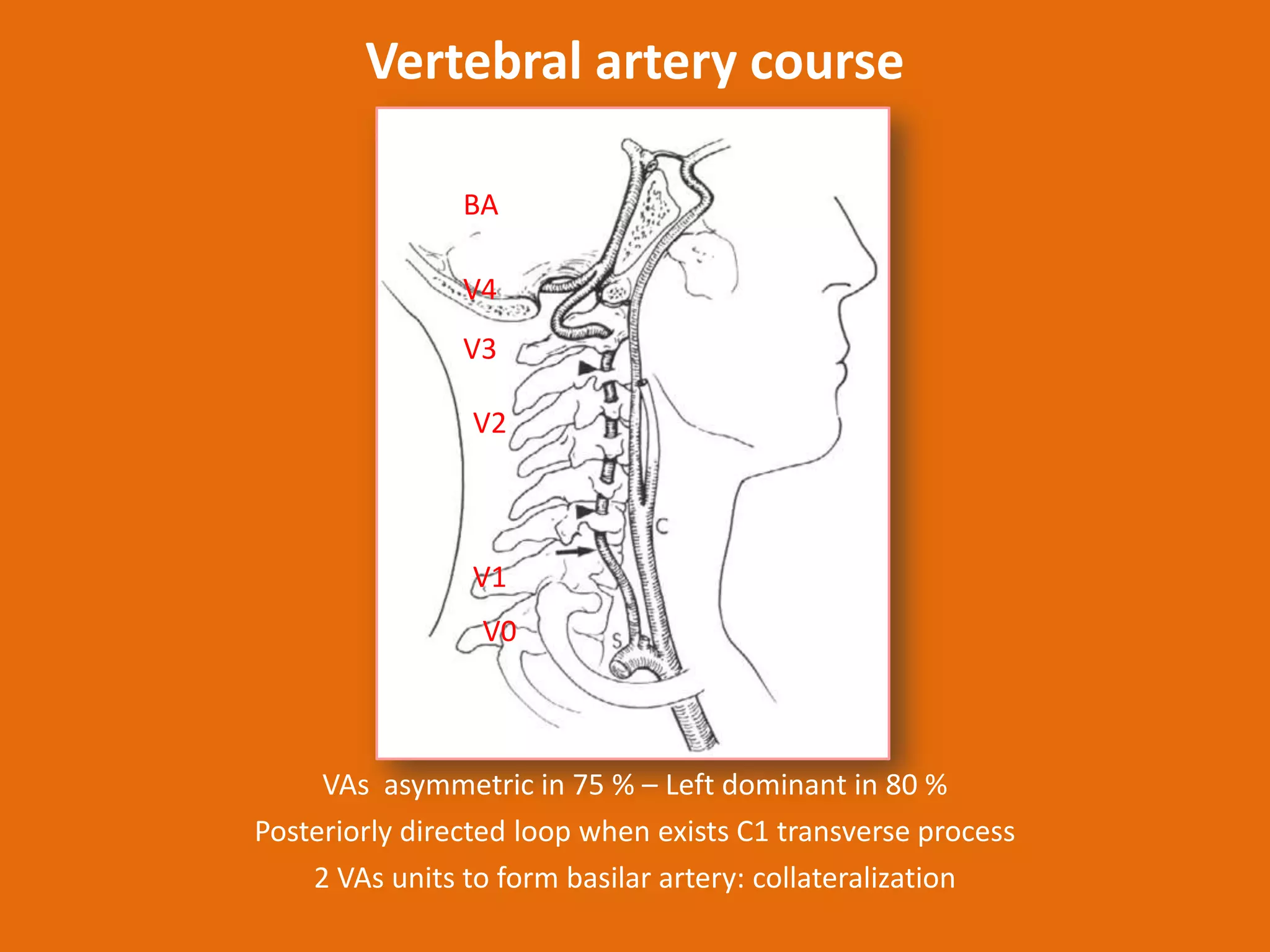 Vertebral artery course
BA
V4
V3
V2

V1
V0

VAs asymmetric in 75 % – Left dominant in 80 %
Posteriorly directed loop when exists C1 transverse process
2 VAs units to form basilar artery: collateralization

 