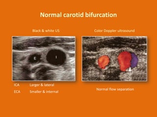 Normal carotid bifurcation
Black & white US

ICA

Larger & lateral

ECA

Smaller & internal

Color Doppler ultrasound

Nor...