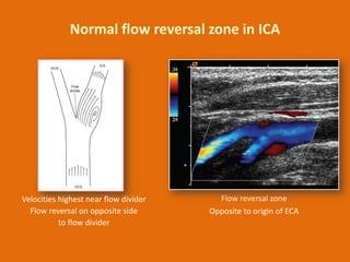 Normal flow reversal zone in ICA

Velocities highest near flow divider
Flow reversal on opposite side
to flow divider

Flo...