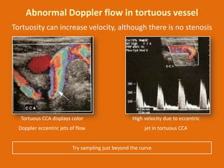 Abnormal Doppler flow in tortuous vessel
Tortuosity can increase velocity, although there is no stenosis

Tortuous CCA dis...
